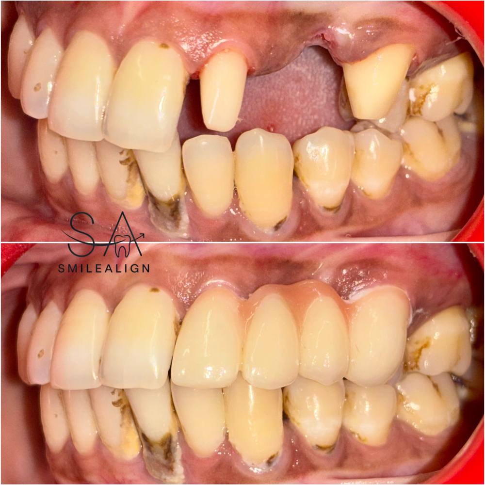 Smile Align Dental Care case 1