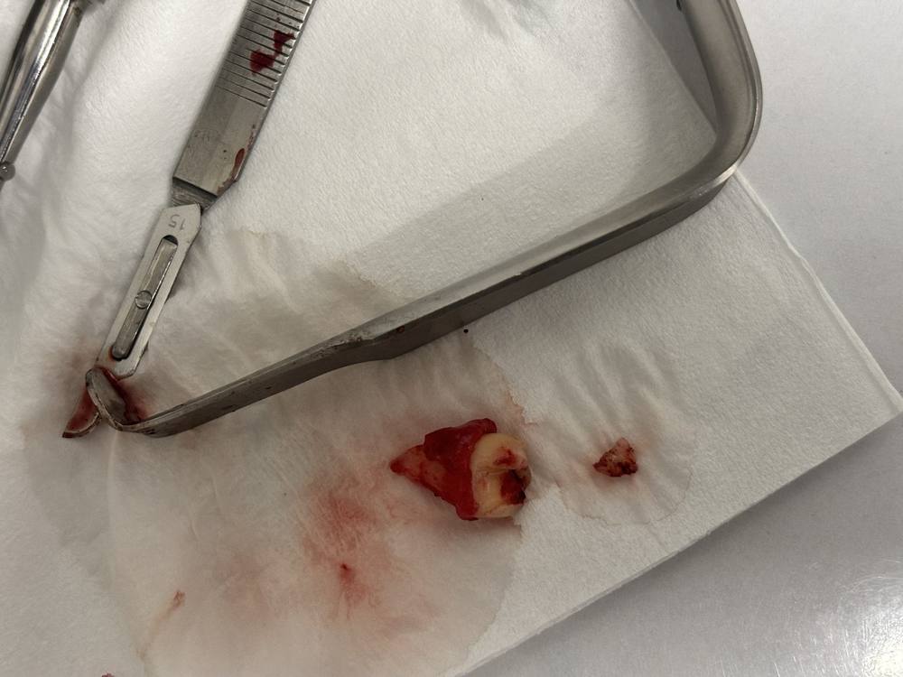 Smile Align Dental Care case 2