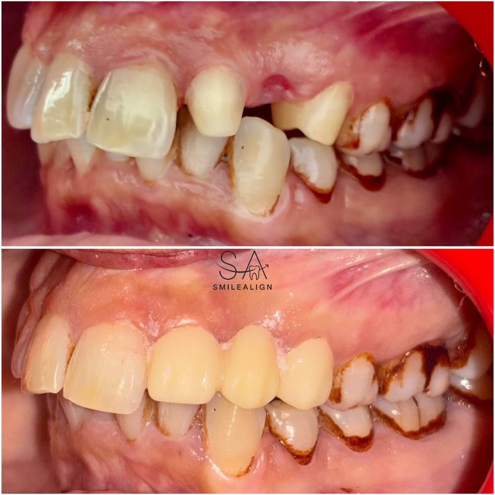 Smile Align Dental Care case 3