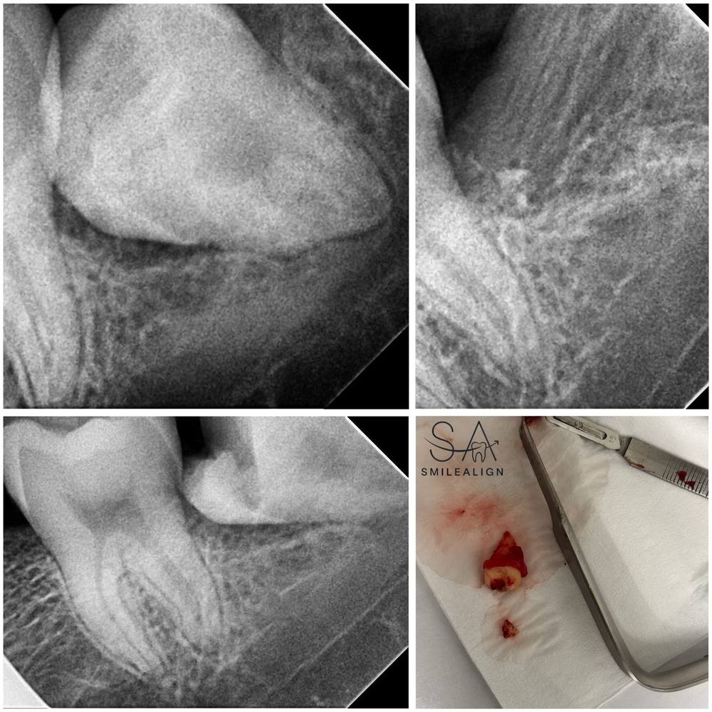 Smile Align Dental Care case 4
