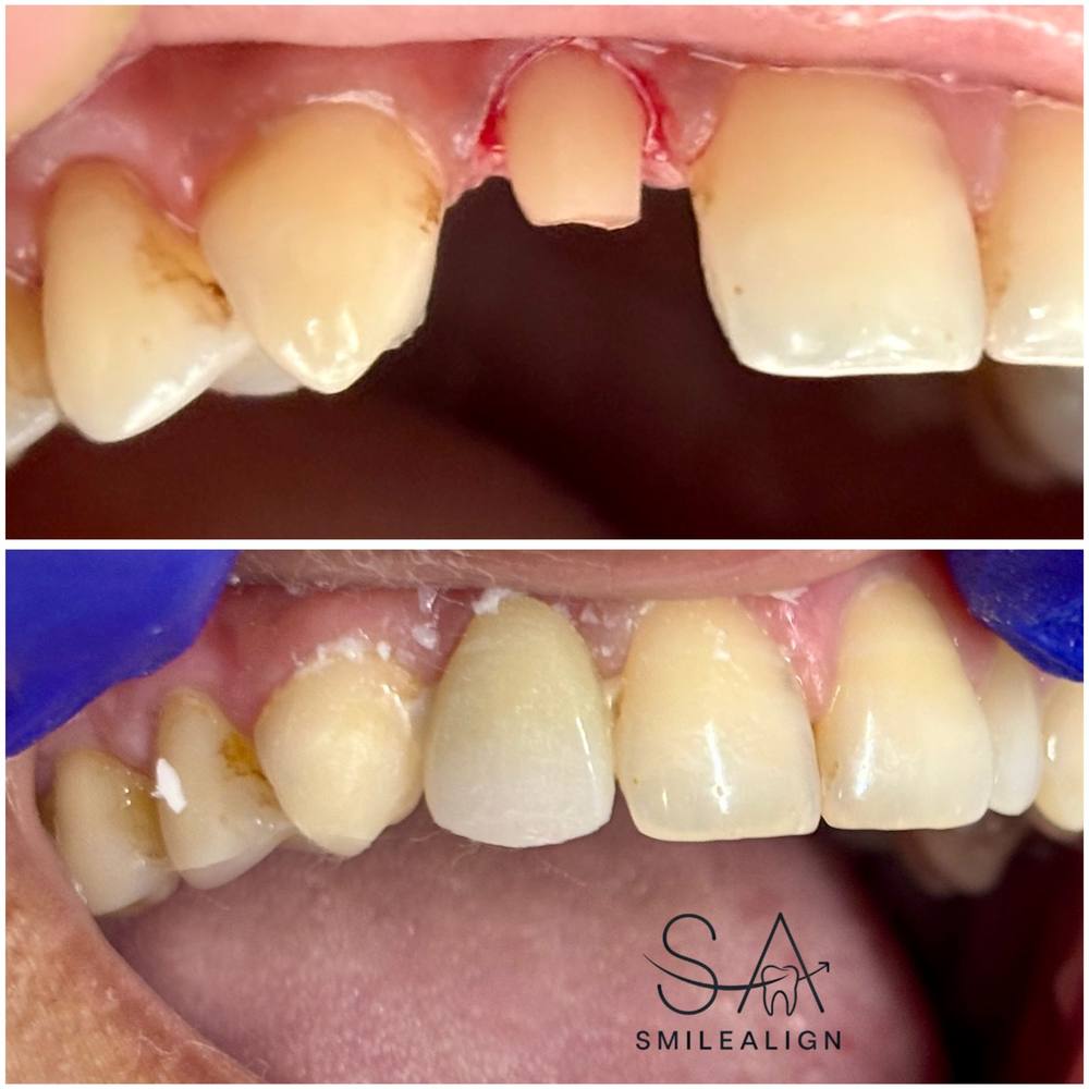 Smile Align Dental Care case 5