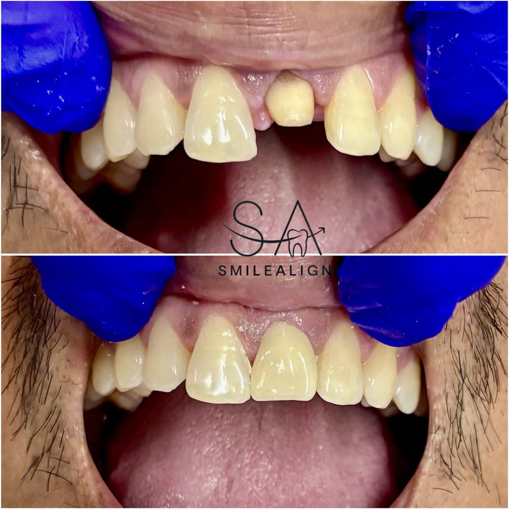 Smile Align Dental Care case 6