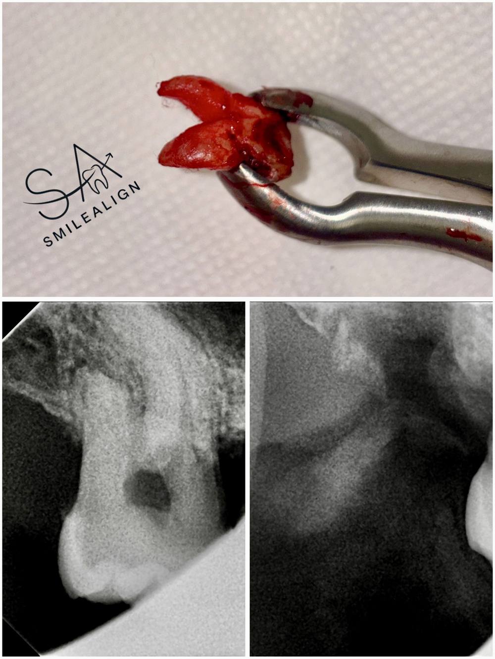 Smile Align Dental Care case 7
