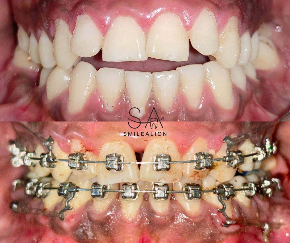 Smile Align Dental Care case 8