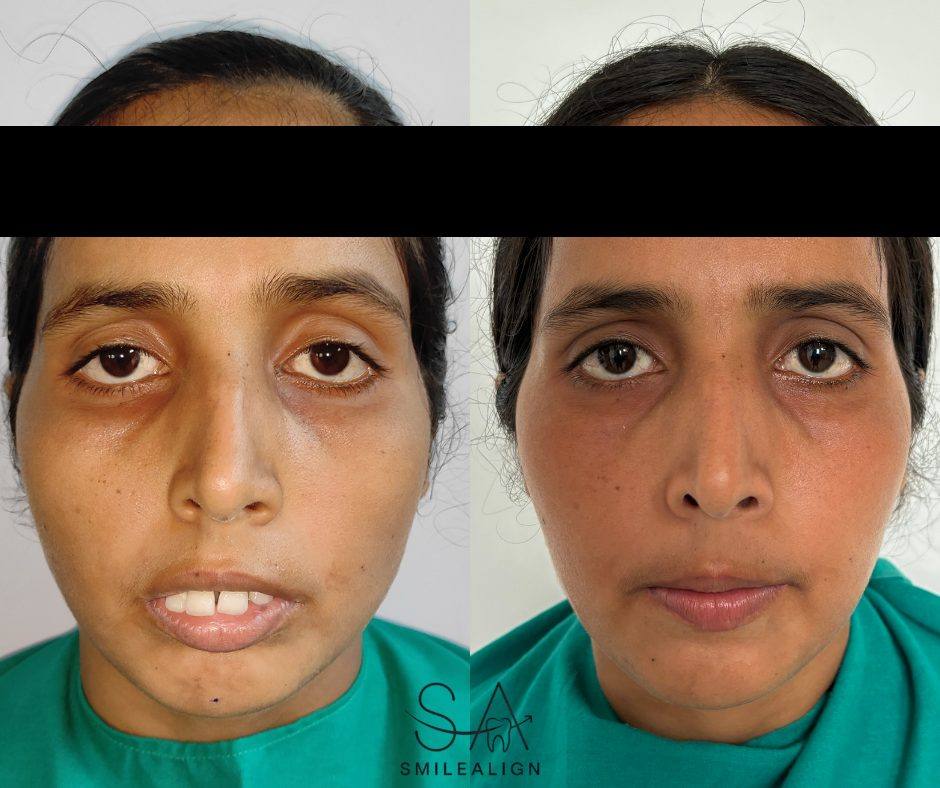 Smile Align Dental Care case 9