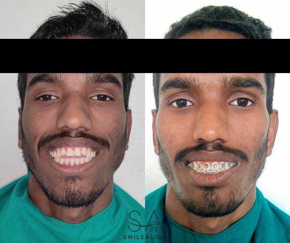 Smile Align Dental Care case 10