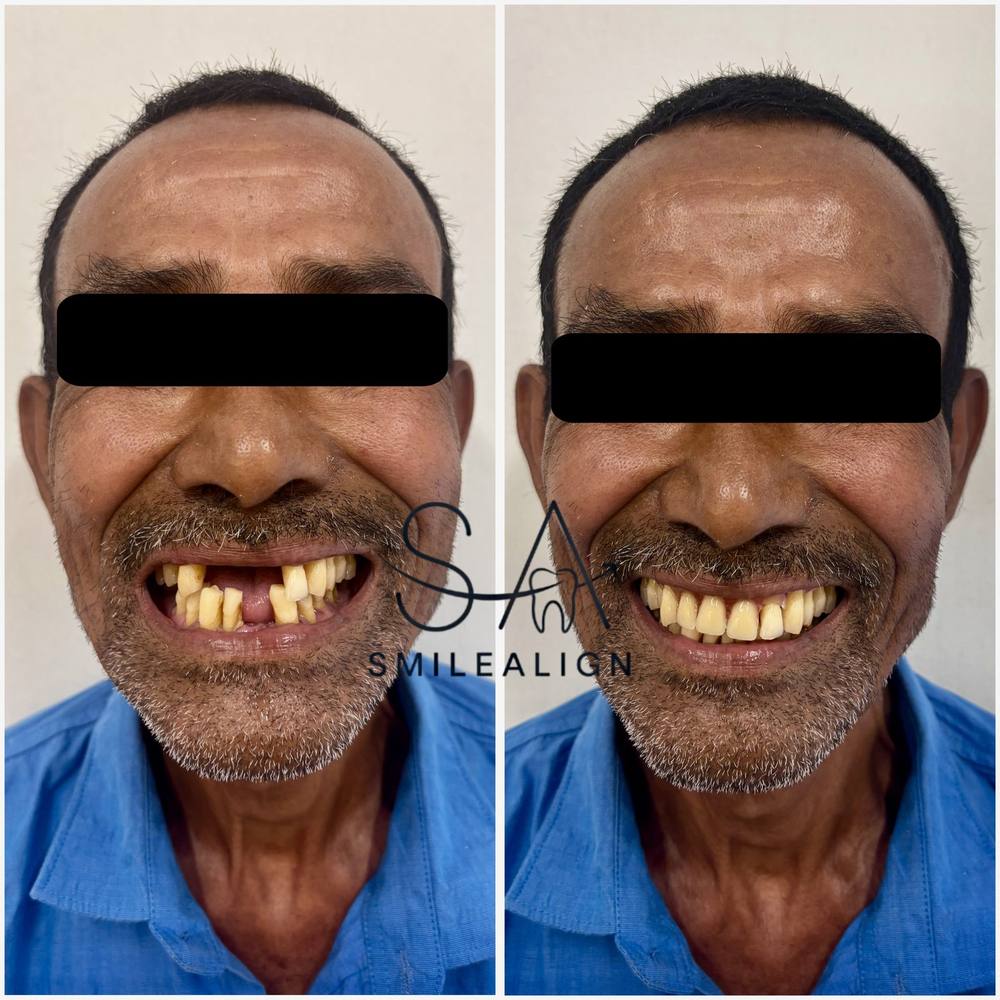 Smile Align Dental Care case 11