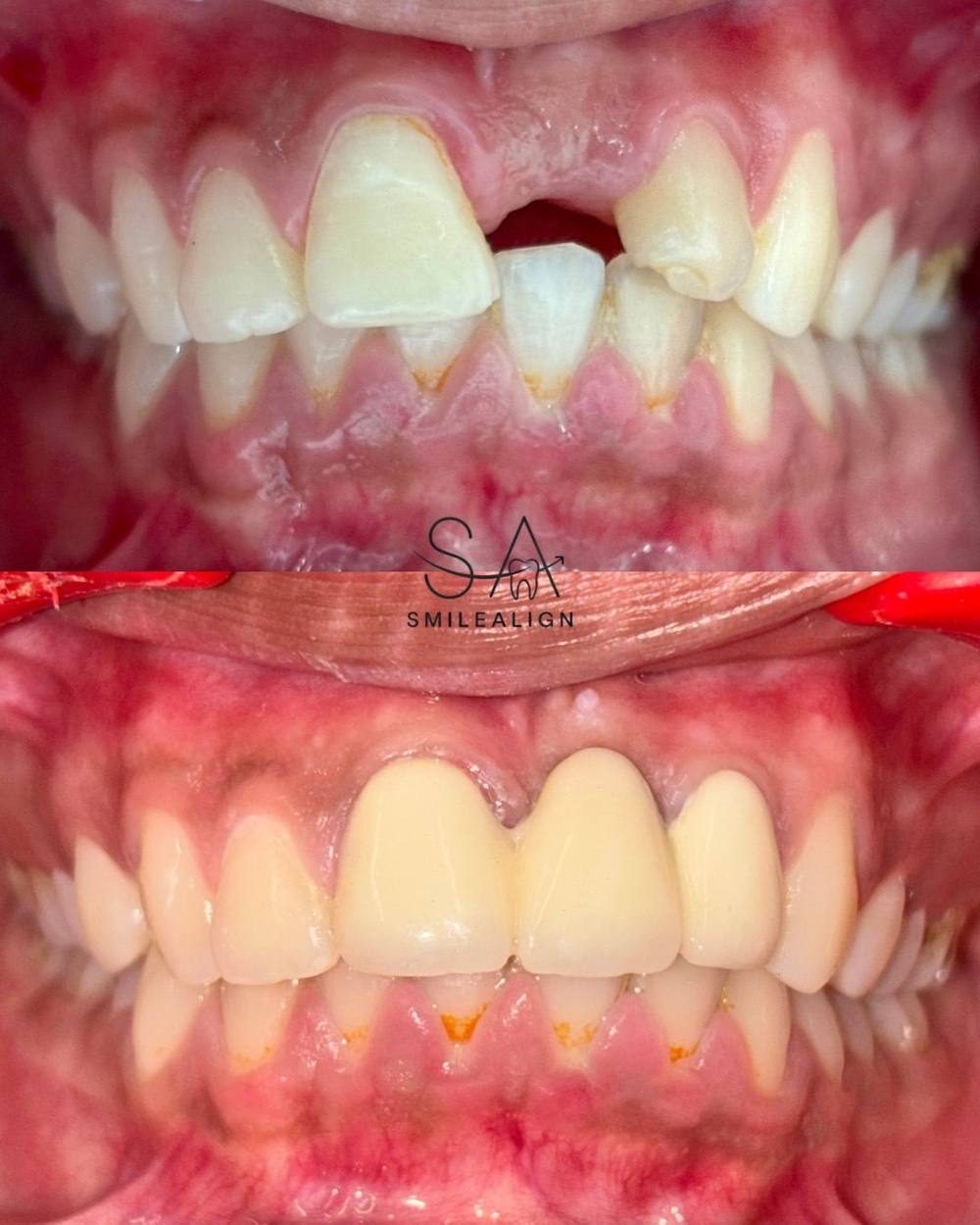 Smile Align Dental Care case 12