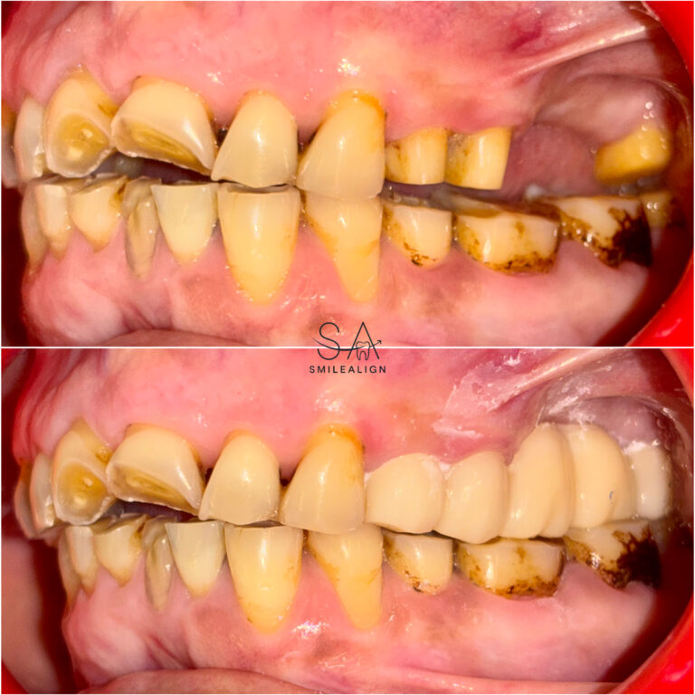 zirconia crowns