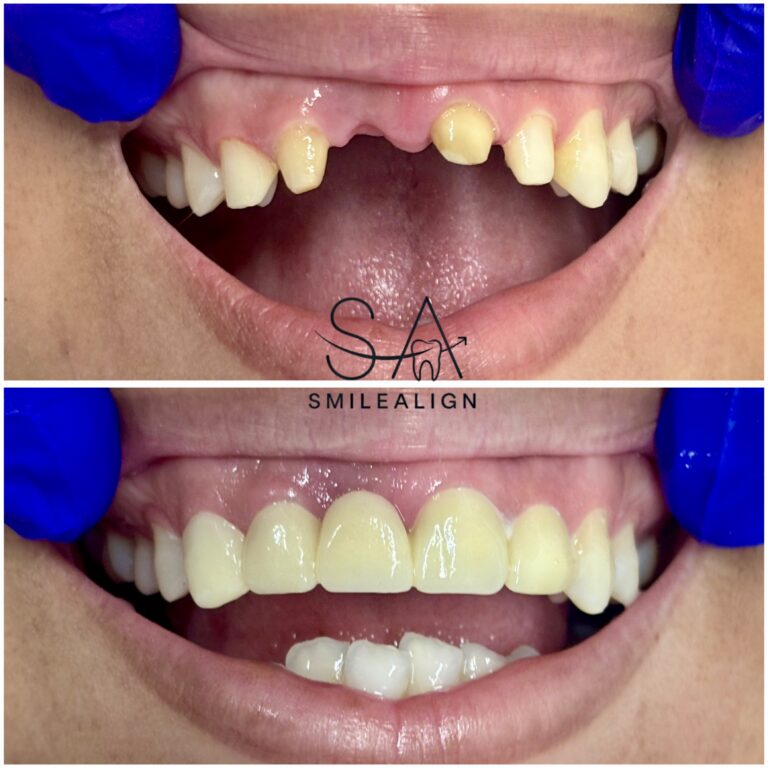 missing teeth replacement