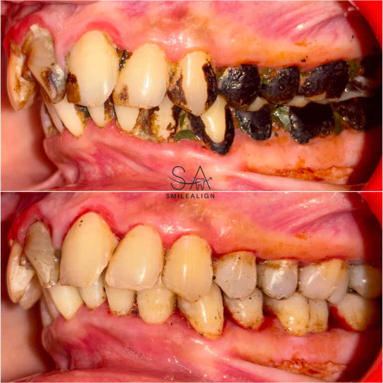 Teeth Cleaning