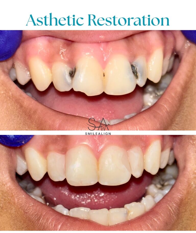 Composite restoration or filling
