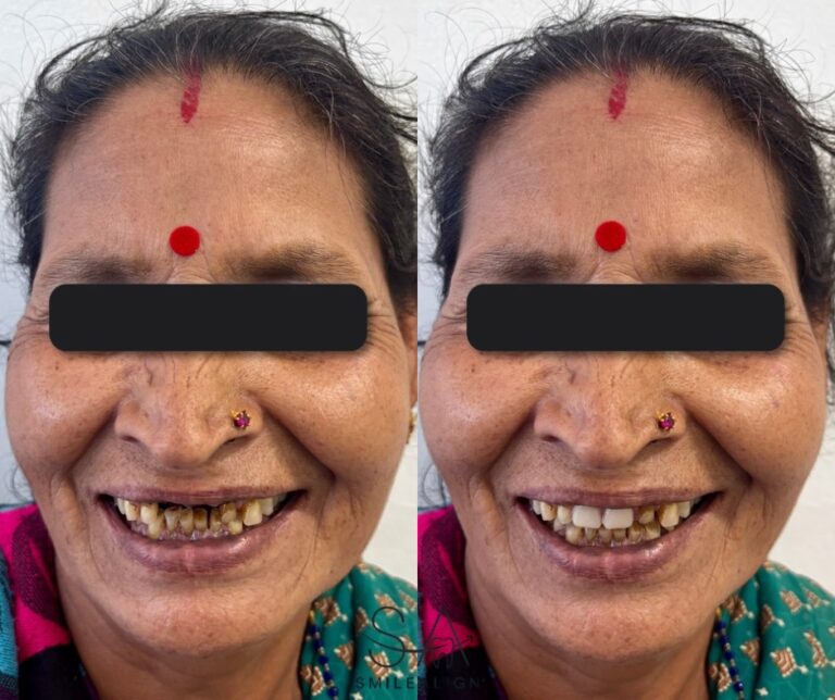 Removeable teeth