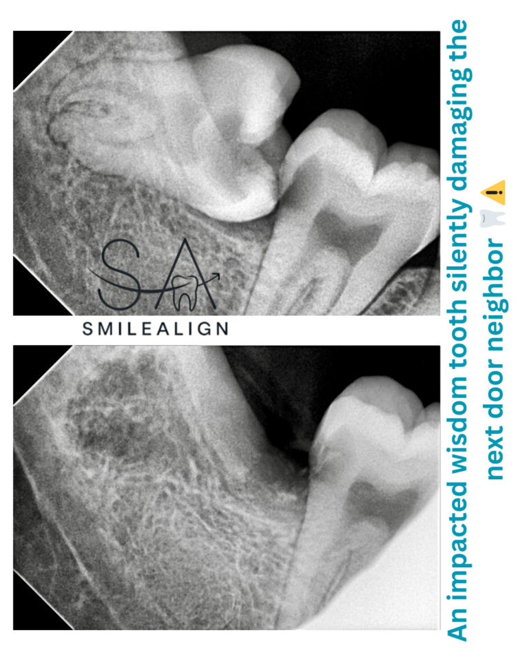 Surgical wisdom teeth extraction